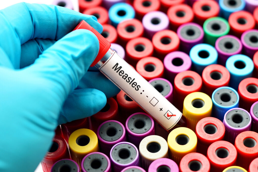 New measles exposures reported in Edmond New measles exposures reported in Edmond