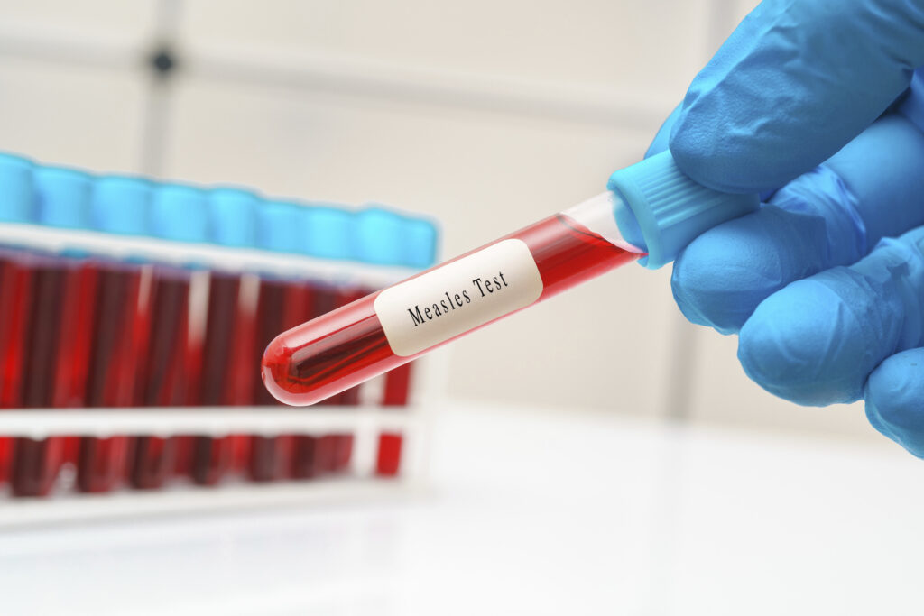 New Mexico health officials report measles exposures in San Juan, Lea county hospitals New Mexico health officials report measles exposures in San Juan, Lea county hospitals