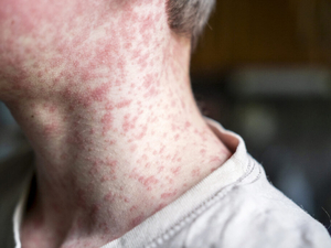 Exemption for moral, ethical beliefs zapped from DeSantis administration’s proposed vax rule