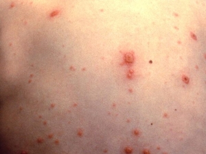 As state considers vaccine changes, new online tool examines sickness, death, cost impacts