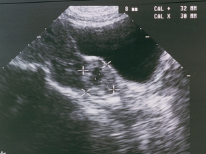 Ectopic pregnancy deaths have nearly doubled. It’s worse in states, like Texas, with abortion bans.