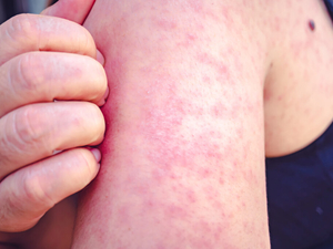 Kentucky’s measles outbreak continues to grow