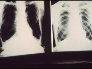 Local leaders support boosting black lung benefits. That consensus hasn’t emerged in Congress.