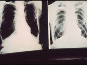 Eastern Kentucky group urges Rep. Rogers to support bill boosting black lung benefits