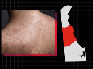 Delaware reaches 23 measles cases, still localized to Kent County