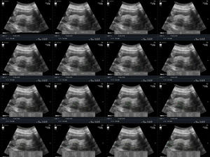 NJ lawmakers, doctors seek to raise awareness of uterine fibroids