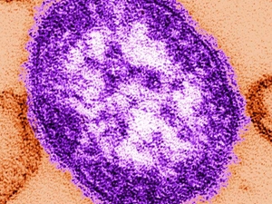 Public health officials warn of rise in measles, as Va. hantavirus patient under monitor