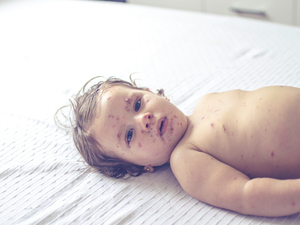 Measles spread in Wisconsin; almost everyone made ill is unvaccinated, health officials say
