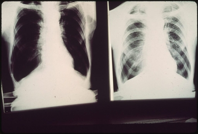 X-rays of a patient with black lung disease. (National Archives at College Park photo)