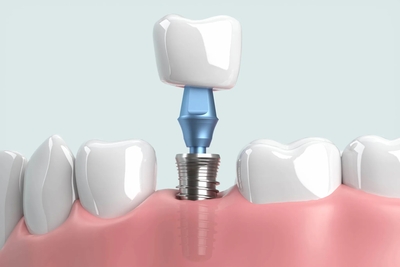 Dentists are pulling ‘healthy’ and treatable teeth to profit from implants, experts warn