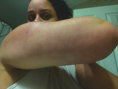 How Long COVID has become the ‘silent pandemic’