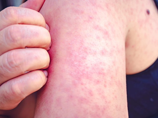 Diseases like measles have surged to the highest level in decades in the United States.(Photo by Getty Images Plus)