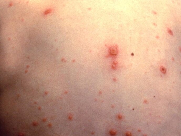 As state considers vaccine changes, new online tool examines sickness, death, cost impacts
