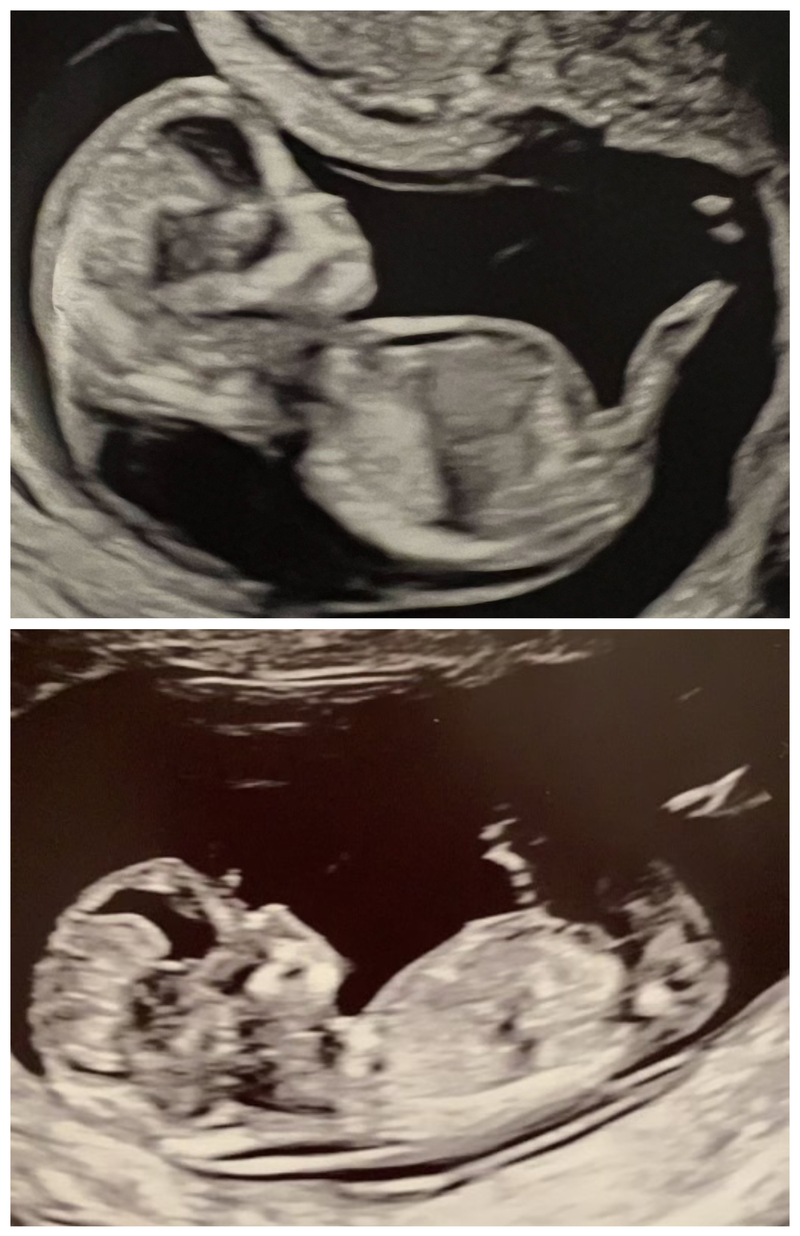 A comparison of the ultrasound of Jennifer Adkins’ 12-week-old fetus, top, with her now 19-month-old son when he was in utero. Adkins said she was struck by the amount of fluid present at the back of the neck and the visible fluid under the skin in the abdominal area. (Courtesy of Jennifer Adkins)