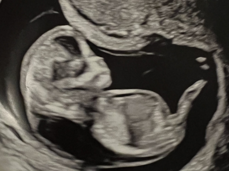 ​​​​An ultrasound image of Jennifer Adkins’ 12-week-old fetus that was diagnosed with Turner syndrome and hydrops fetalis, two defects that are often fatal to the fetus and dangerous for the pregnant person to carry. Adkins had to seek an abortion in Oregon because, like 13 other states across the country, Idaho has a near-total ban on abortions without exceptions provided to preserve the health of the pregnant person. (Courtesy of Jennifer Adkins)