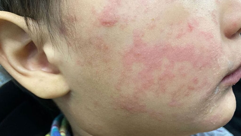 As measles cases tick higher, many NC counties could see outbreaks. 