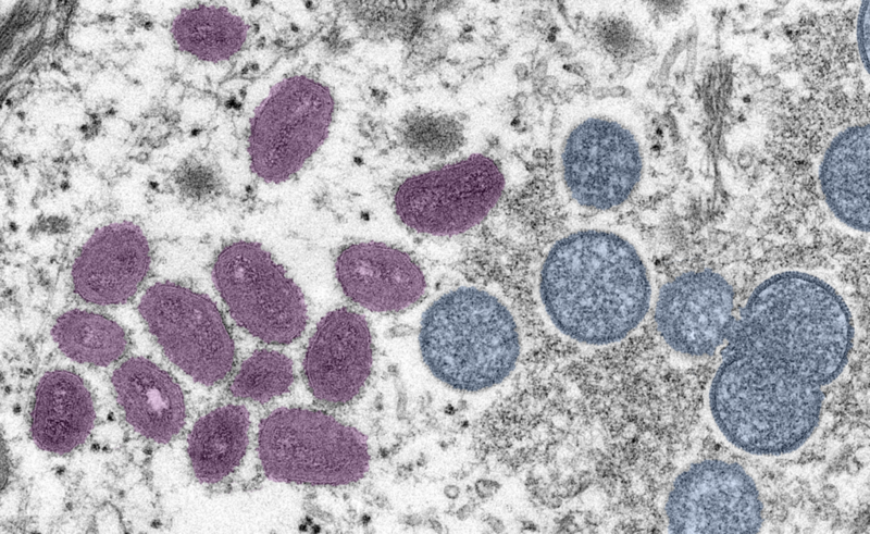 Monkeypox outbreak: Cases climb to 180 in FL; federal health officials expand testing through labs