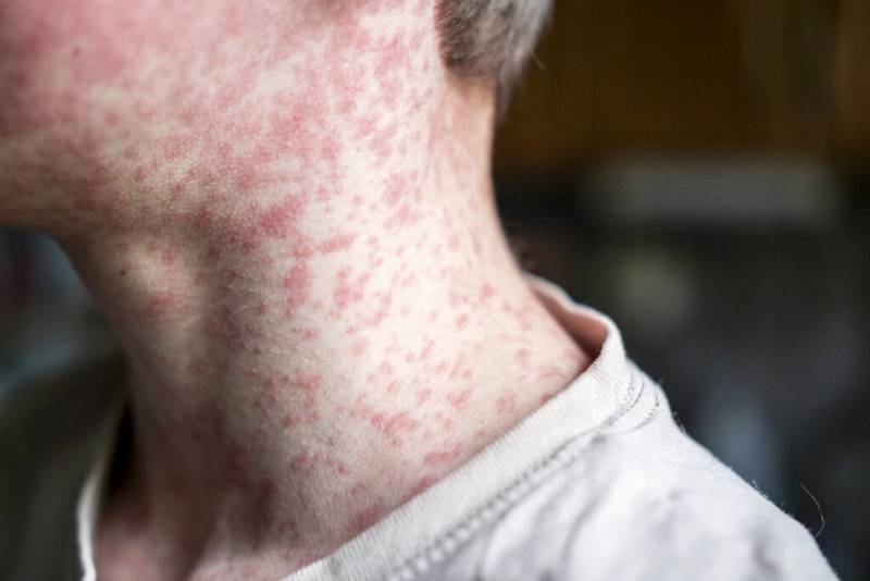 Exemption for moral, ethical beliefs zapped from DeSantis administration’s proposed vax rule
