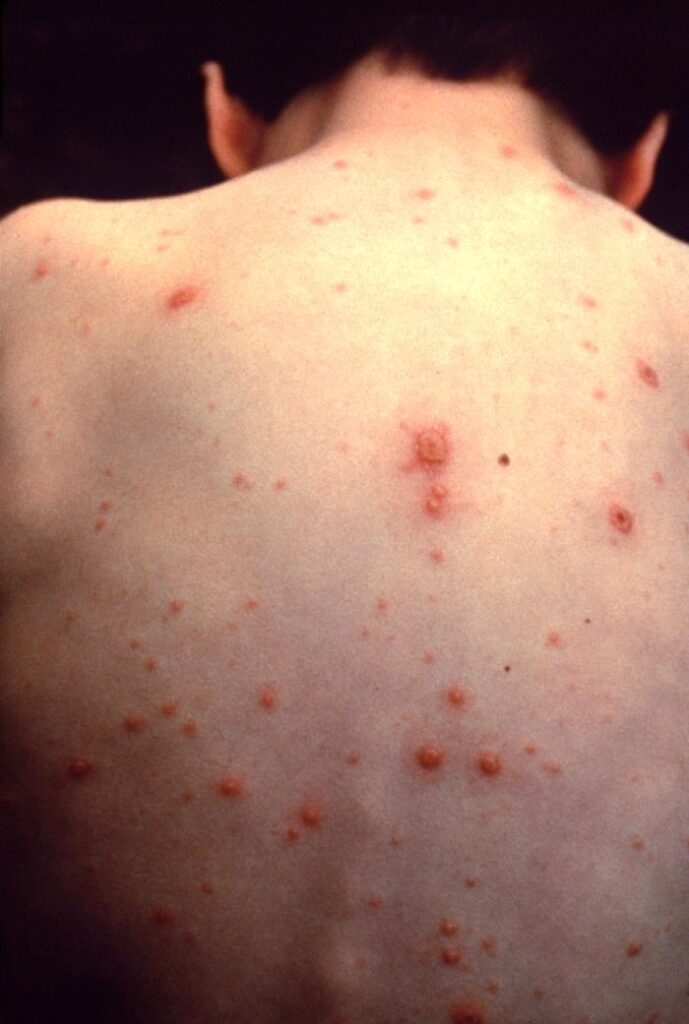 As state considers vaccine changes, new online tool examines sickness, death, cost impacts
