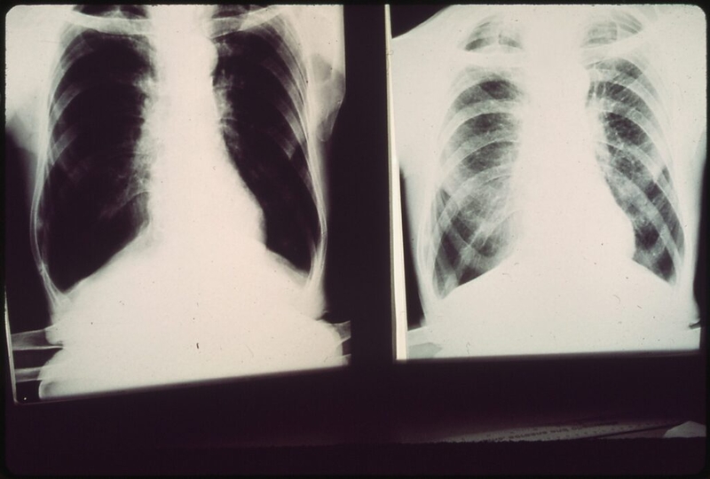 Eastern Kentucky group urges Rep. Rogers to support bill boosting black lung benefits