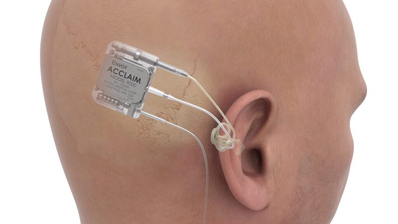 MUSC to study first-ever fully internal cochlear implants as part of national trial