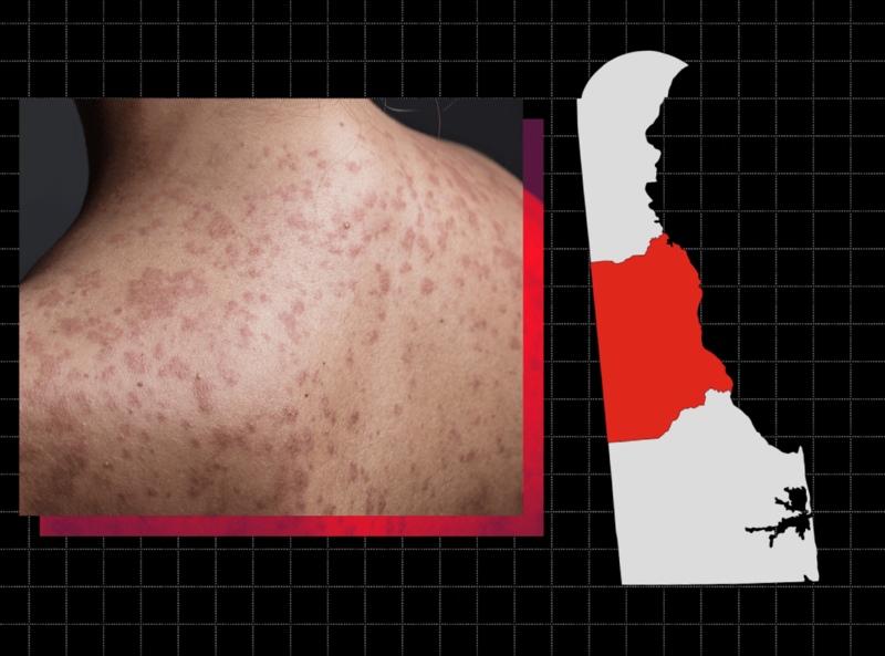 Delaware declares measles outbreak days after first case
