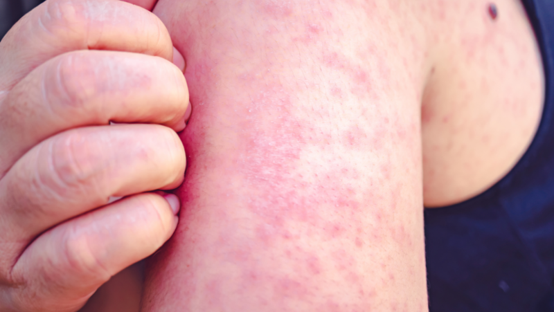 New Orleans-area child contracts measles; public exposed in Kenner
