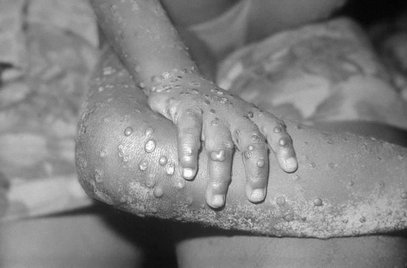 Health officials announce Virginiaâs first presumed monkeypox case