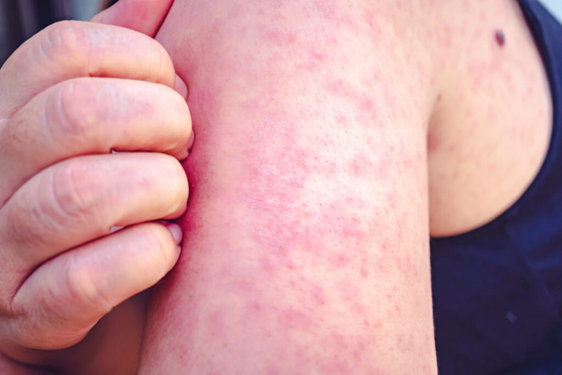 Measles outbreak in Southwest Wisconsin grows; most taken ill weren’t vaccinated