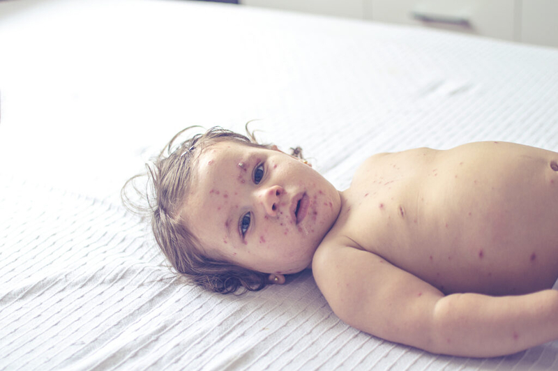 Measles spread in Wisconsin; almost everyone made ill is unvaccinated, health officials say
