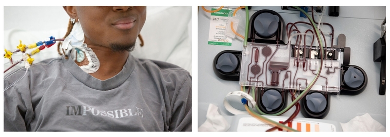 Side-by-side photos show Daniel Cressy with tubes leading to and from his body and the system that collects stem cells from his blood to treat his sickle cell anemia.